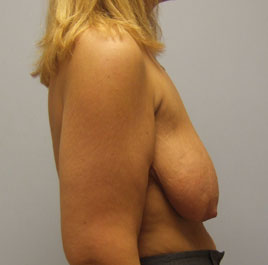 Breast Lift Before & After Image