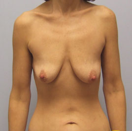 Breast Lift Before & After Image