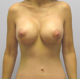 Breast Lift Before & After Image