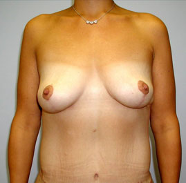 Breast Lift Before & After Image