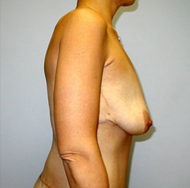 Breast Lift Before & After Image