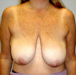 Breast Lift Before & After Image