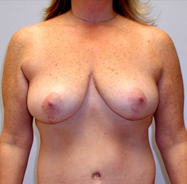 Breast Lift Before & After Image