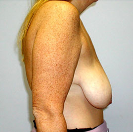 Breast Lift Before & After Image