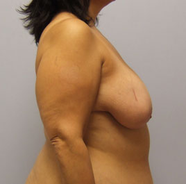 Breast Lift Before & After Image