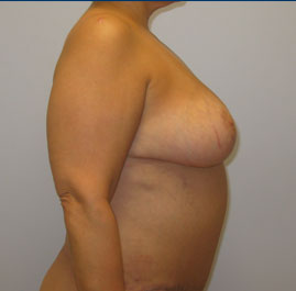 Breast Lift Before & After Image