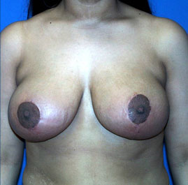 Breast Lift Before & After Image