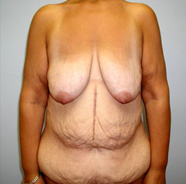 Breast Lift Before & After Image