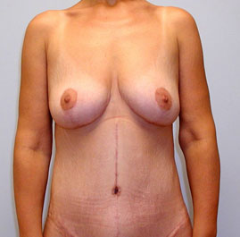 Breast Lift Before & After Image