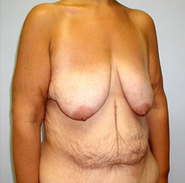 Breast Lift Before & After Image