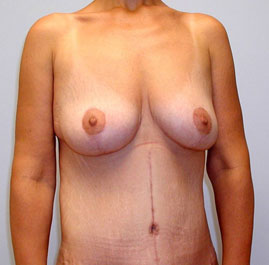 Breast Lift Before & After Image