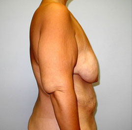 Breast Lift Before & After Image