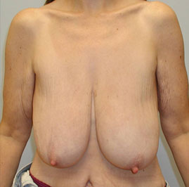 Breast Lift Before & After Image