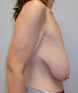 Breast Lift Before & After Image