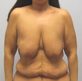 Breast Lift Before & After Image