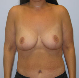 Breast Lift Before & After Image