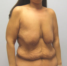 Breast Lift Before & After Image