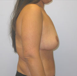 Breast Lift Before & After Image