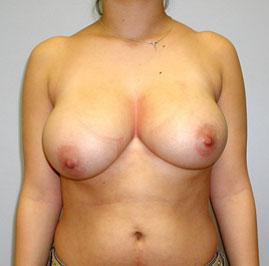 Breast Lift Before & After Image