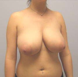 Breast Lift Before & After Image