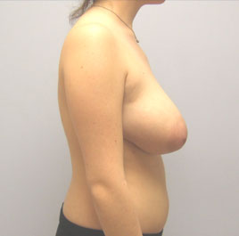 Breast Lift Before & After Image