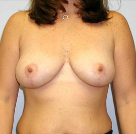 Breast Lift Before & After Image