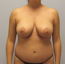 Breast Lift Before & After Image