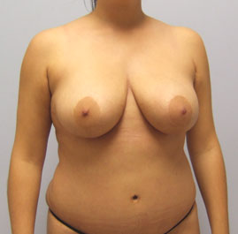 Breast Lift Before & After Image