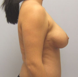 Breast Lift Before & After Image