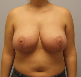 Breast Lift Before & After Image