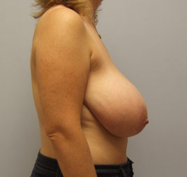 Breast Lift Before & After Image