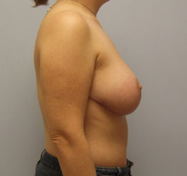 Breast Lift Before & After Image