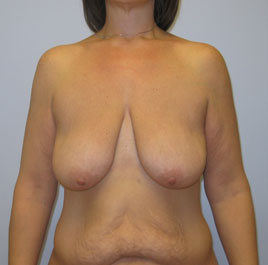 Breast Lift Before & After Image