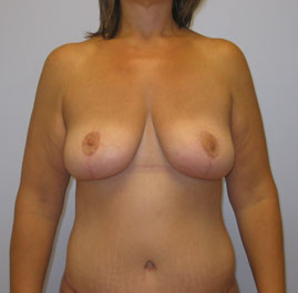 Breast Lift Before & After Image