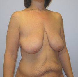 Breast Lift Before & After Image