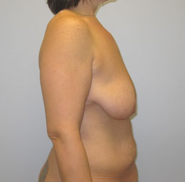 Breast Lift Before & After Image