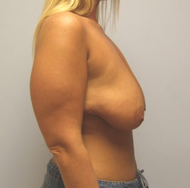 Breast Lift Before & After Image