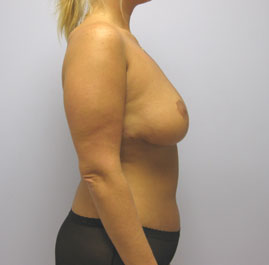 Breast Lift Before & After Image