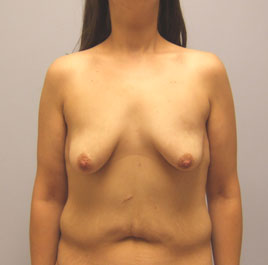 Breast Lift Before & After Image