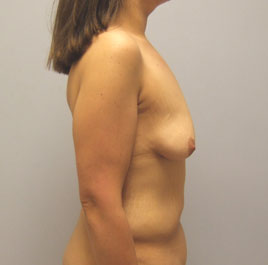 Breast Lift Before & After Image