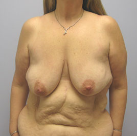 Breast Lift Before & After Image