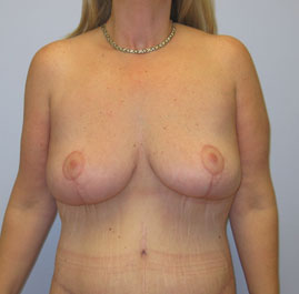 Breast Lift Before & After Image