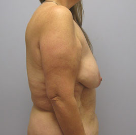 Breast Lift Before & After Image