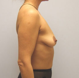 Breast Lift Before & After Image