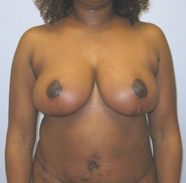 Breast Lift Before & After Image