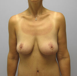 Breast Lift Before & After Image