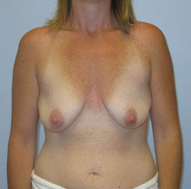 Breast Lift Before & After Image