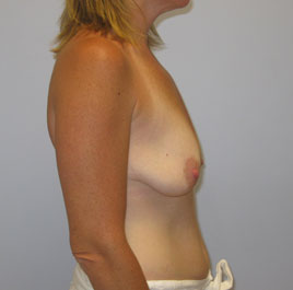 Breast Lift Before & After Image