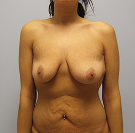 Breast Lift Before & After Image