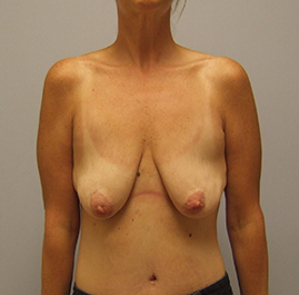 Breast Lift Before & After Image